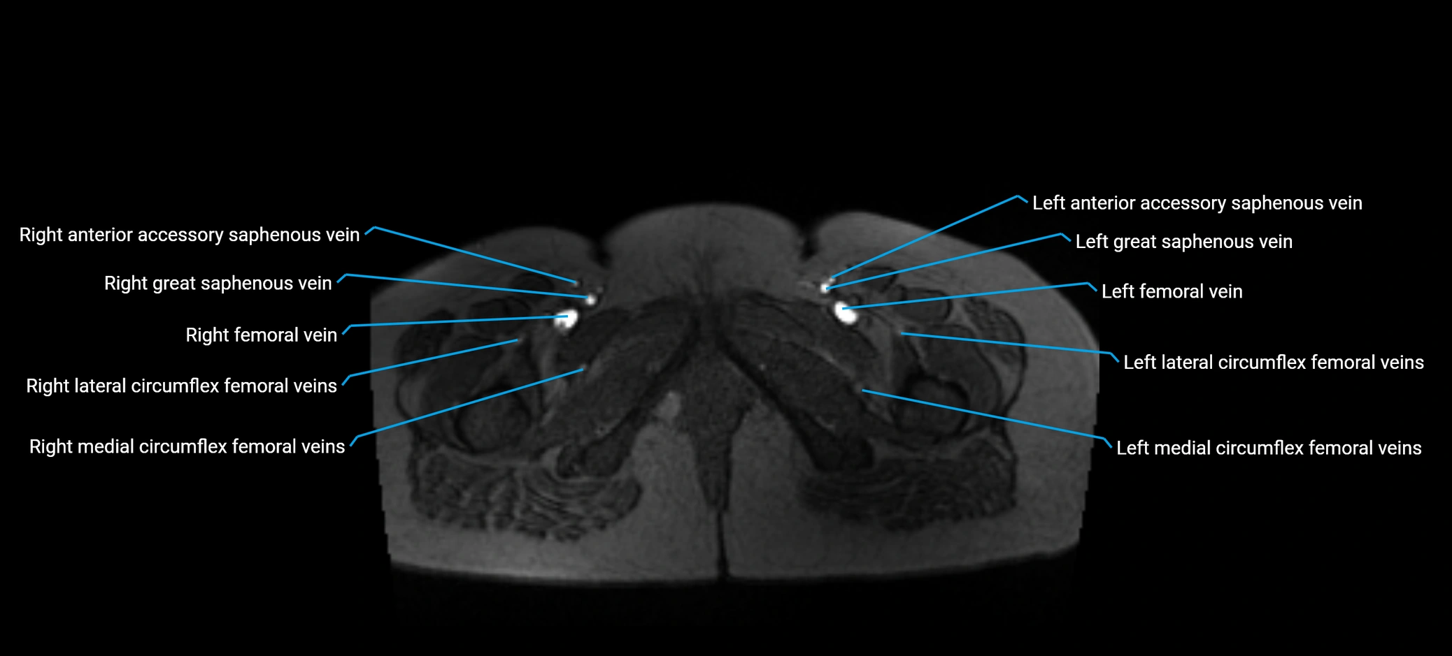 MRV abdomen pelvis & lower limb axial cross sectional anatomy labelled MRI image 200 (1).webp